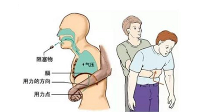 海姆利克急救法體感方法1：成人立位腹部沖擊法